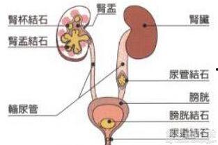 输尿管结石可以吃葫芦瓜,天然食疗的神奇功效